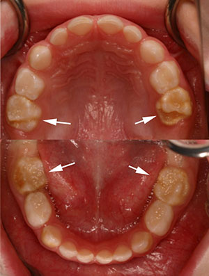 Hypomineralization on the Secondary Primary Molars and Cuspids