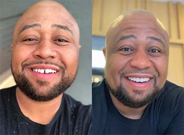 A “Before” and “After” photo from the SmileDirectClub website.
